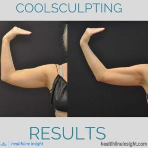 CoolSculpting before and after